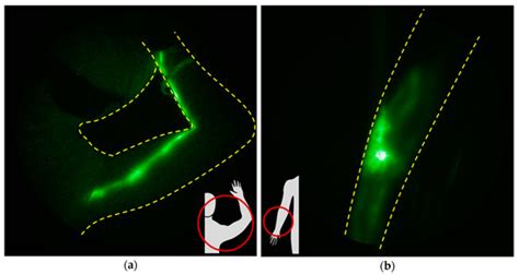 The Development and Treatment of Lymphatic Dysfunction in Cancer ...