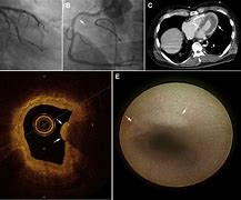 Image result for periarteritis