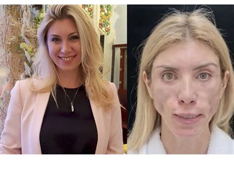 With plastic surgery gone wrong, Russian beauty queen left disfigured ...