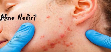 Akne Vulgaris (Sivilce) - Sayfa 2