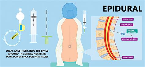 Image result for Epidural Injection Procedure