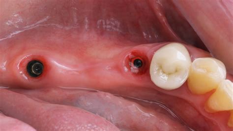 Dental implant procedure: everything you need to know - Body Expert