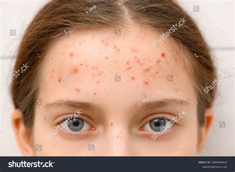 Image result for Exploding Face Zits