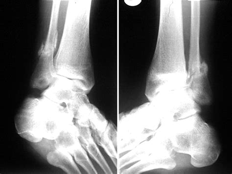 Fibula Stress Fracture