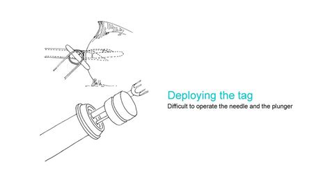 D'source Case Study - Slide Show | Deployer Device for Endo Retractor ...