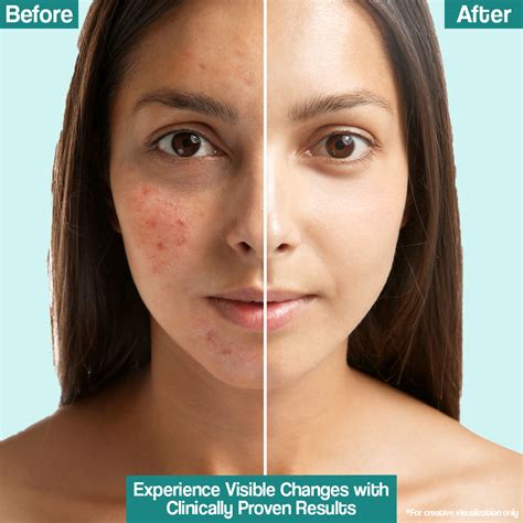 Venusia Acne Control Moisturizer Cream | Uses, Side Effects, Price ...