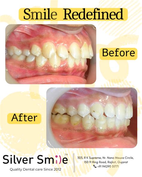 Best Invisalign Treatment in Rajkot | Affordable Clear Aligners ...