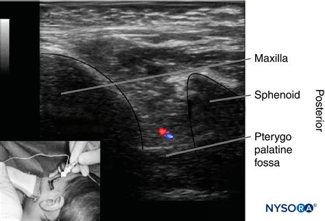 regional-anesthesia-ultrasound-imaging-for-the-pterygopalatine-fossa ...