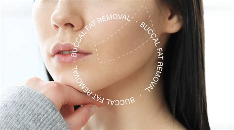Buccal Fat Removal Jakarta at Janie Clark blog