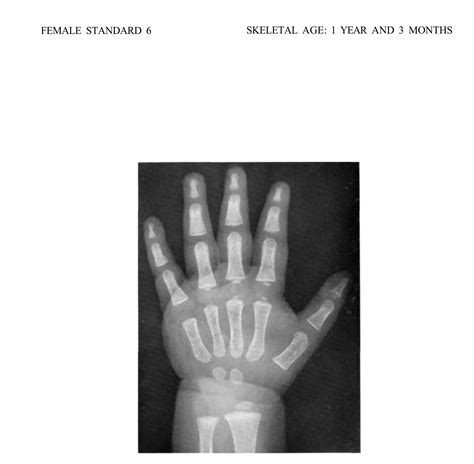 bone age atlasbone age atlas bone age atlas | PDF