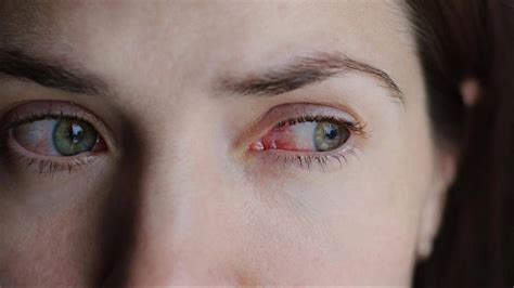 Why Are Your Eyes Itchy And How To Stop It Now