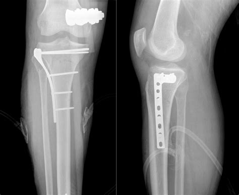 Open reduction internal fixation (ORIF) of tibial plateau fracture ...