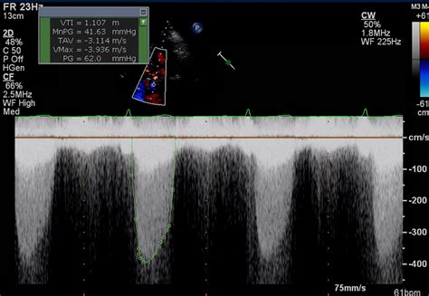 How to Scan Patients With Severe Aortic Stenosis | JACC: Case Reports