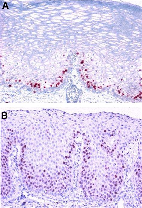 References in Microscopic Esophageal Mucosal Injury in Nonerosive Reflux Disease - Clinical ...