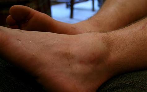 swollen ankle no pain - Cawley Physical Therapy