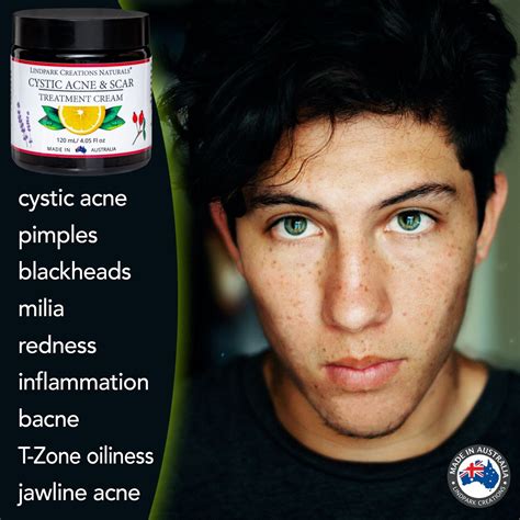 Cystic Acne & Scar Cream 120mL - Tea Tree, Aloe, Lavender Lemon Made in ...