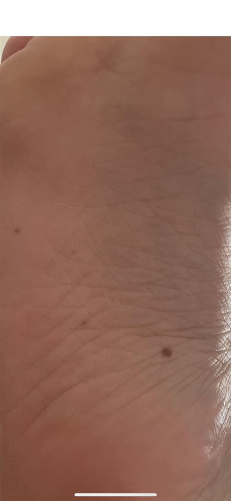 Are moles on palm and sole dangerous? : r/Melanoma