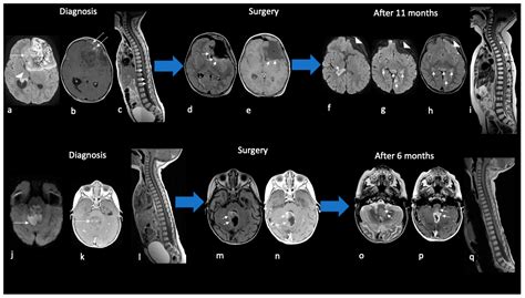 Atypical Teratoid Rhabdoid Tumor: Proposal of a Diagnostic Pathway Based on Clinical Features ...