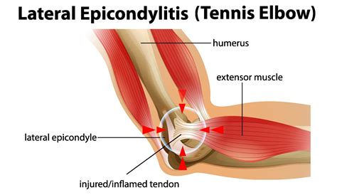 What Causes Tennis Elbow?