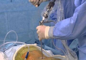 What is endoscopic discectomy?