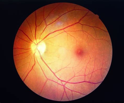 Spotting the Signs of Diabetic Retinopathy | Newsmax.com