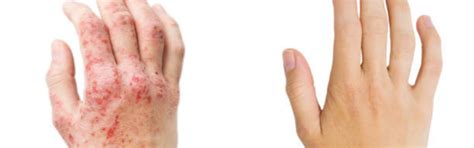 Small Patches - Eczema and Psoriasis Care Bundle – Oleum Cottage