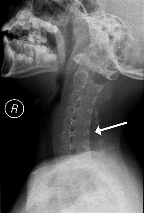 Fibrodysplasia ossificans progressiva - recognising the early features ...