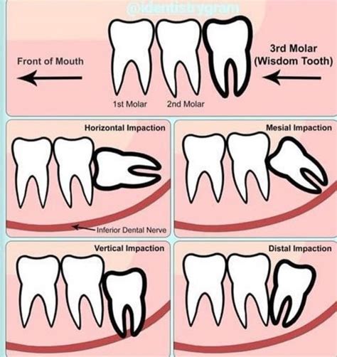 Image result for Wisdom Teeth Impaction Types
