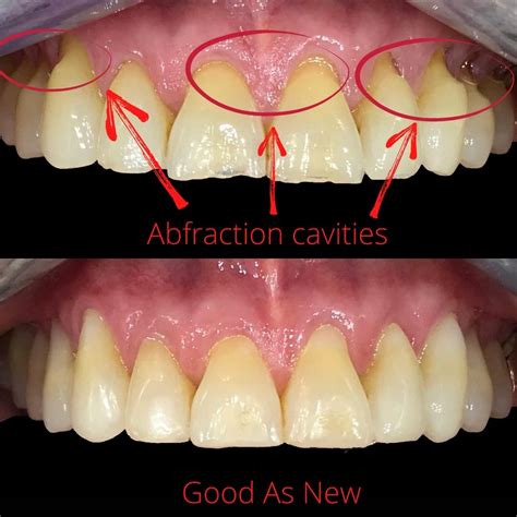 Fine Beautiful Tips About How To Fix Sensitive Teeth - Strangertourist2