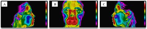 Thermographic Study of the Orofacial Structures Involved in ...