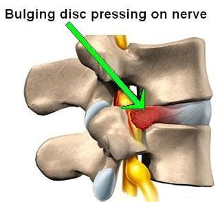 FLEXION OR EXTENSION