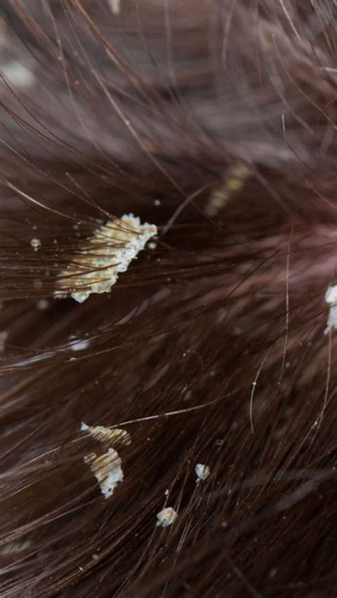 Best home remedies to prevent head lice