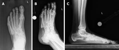 Osteoarthritis In Ankle And Foot at Mackenzie Sheehy blog