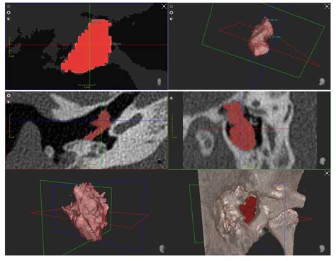 Surgical Guidance for Removal of Cholesteatoma Using a Multispectral 3D ...