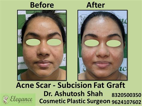 Acne Scar, Subcision Fat Graft in Vesu, Surat