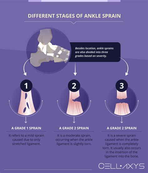 Sprained Ankle Dr Luisa Dillner's Guide To . . . A Sprained Ankle