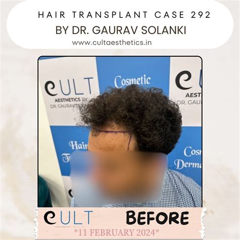 Hair Transplant Results 292 | Cult Aesthetics