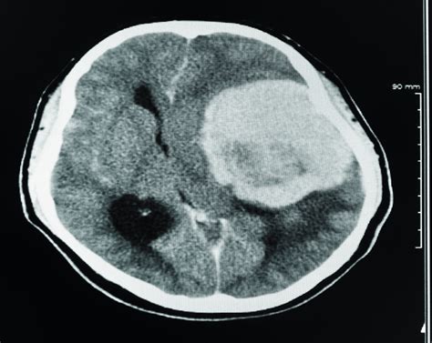 Cat Scan Brain Tumor