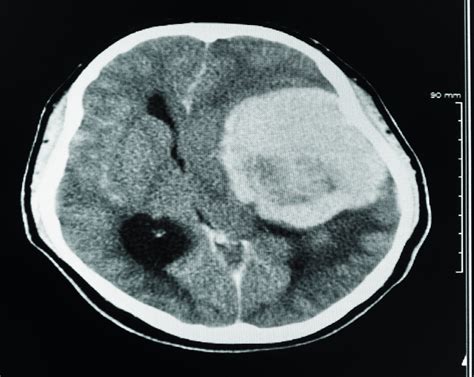 Acute CT Brain - Extra-axial haemorrhage
