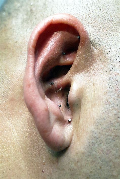 Battlefield Acupuncture's proven pain reduction treatment becoming ...