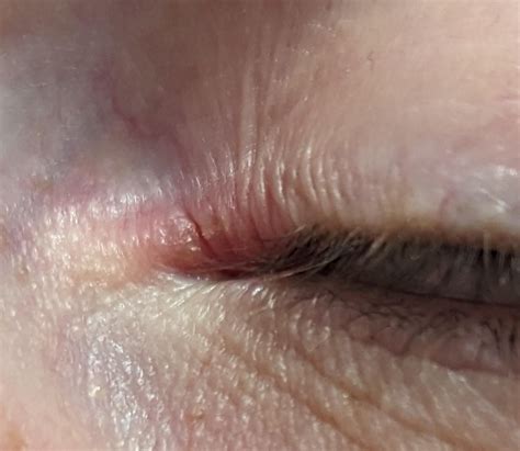 Sore, cracked psoriasis in corner of eye - how to heal ?? : r/Psoriasis