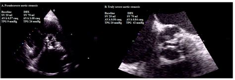 Diagnosis and Management of Aortic Valve Stenosis: The Role of Non-Invasive Imaging