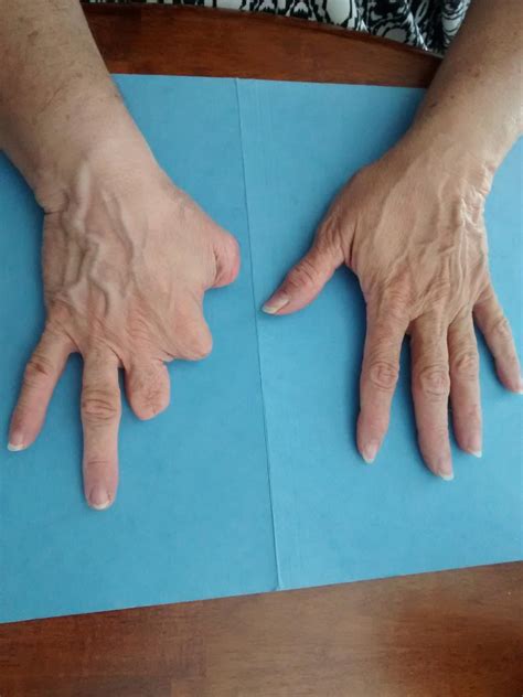 How to Use a Hand Prosthesis 的图像结果