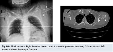 Trivial Trauma Induced Bilateral Proximal End Humerus Fracture: Two ...