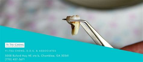 Infected Tooth Extraction Procedure 的图像结果