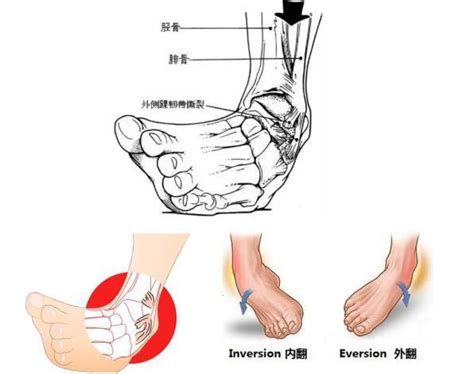 崴脚不是小伤，小心形成习惯性崴脚！|踝关节处|软组织|崴脚|-健康界