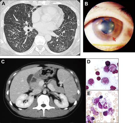 T/NK cell type chronic active Epstein–Barr virus disease in adults: an underlying condition for ...