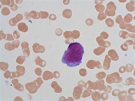 Undifferentiated blast - HORIBA