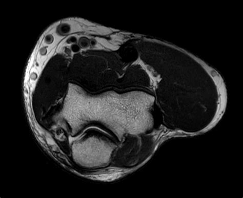 Fat-free elbow imaging | Philips MR Body Map