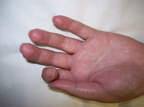 Understanding Reflex Sympathetic Dystrophy (RSD/CRPS) and its Treatment | Piedmont Physical ...